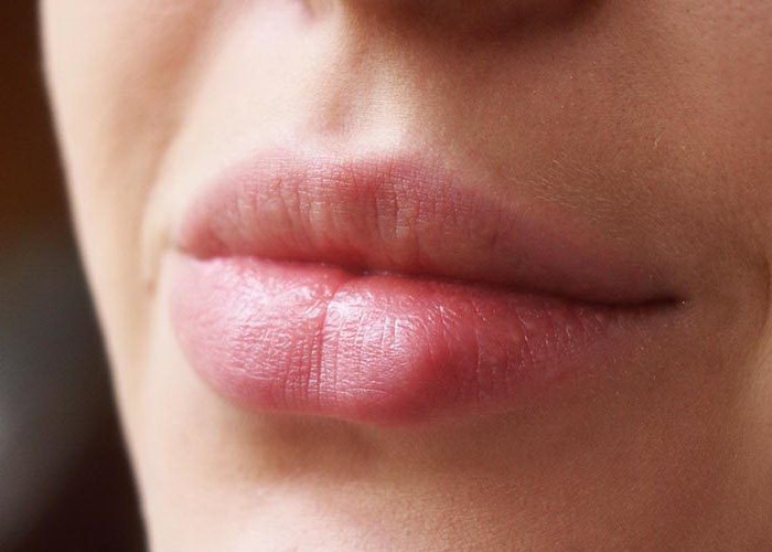 Как вылечить герпес в домашних условиях Как вылечить герпес в домашних условиях